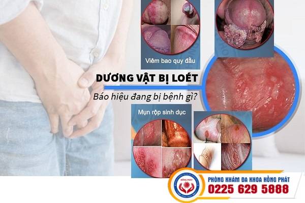 duong-vat-lo-loet