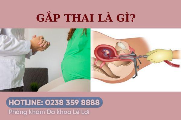 Những điều bạn cần biết về nong gắp thai